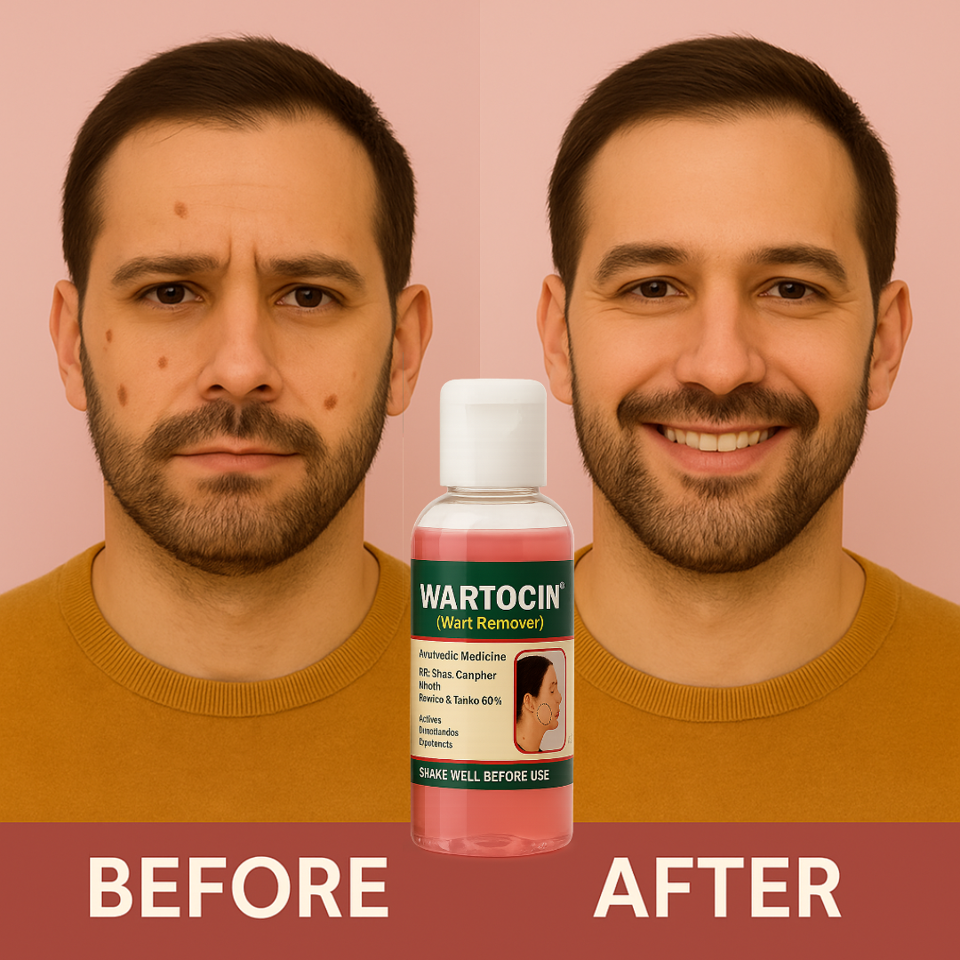 Wartocin Wart & Skin Tag Remover - 30ml