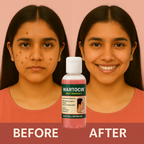 Wartocin Wart & Skin Tag Remover - 30ml