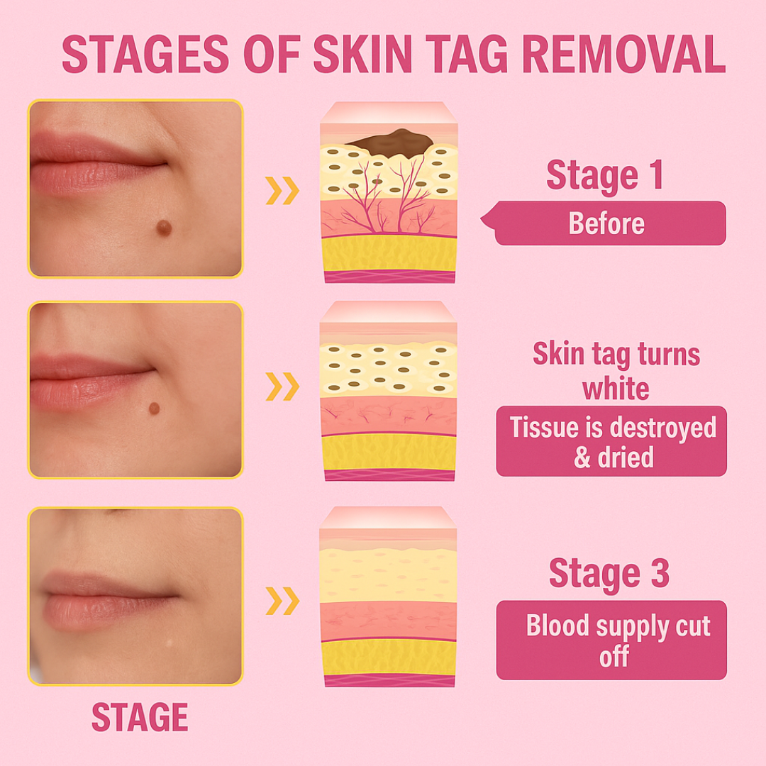 Wartocin Wart & Skin Tag Remover - 30ml