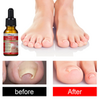 Toenail Nail Care Drops – 1+1 Free ✨ (கால் நக கேர்)