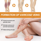 Varicose Veins Relief Herbal Spray - (Buy 1 Get 1 FREE🔥🔥)