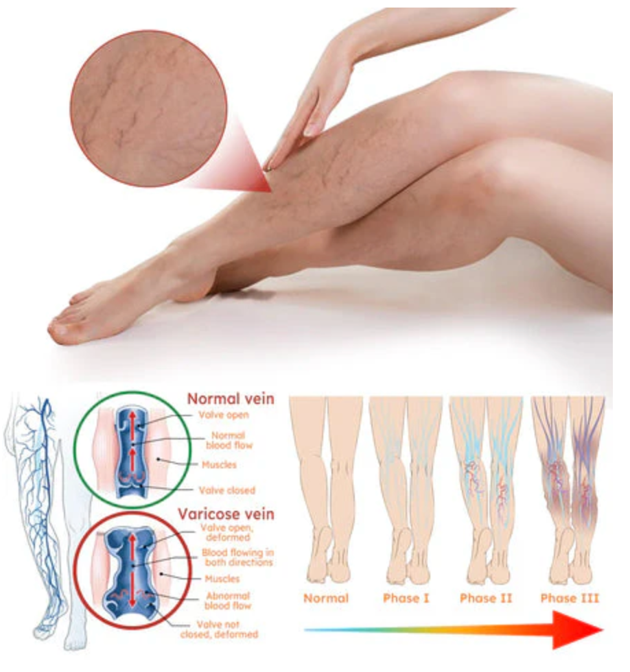 Varicose Veins Relief Herbal Spray - (Buy 1 Get 1 FREE🔥🔥)