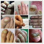 Toenail Nail Care Drops – 1+1 Free ✨ (கால் நக கேர்)